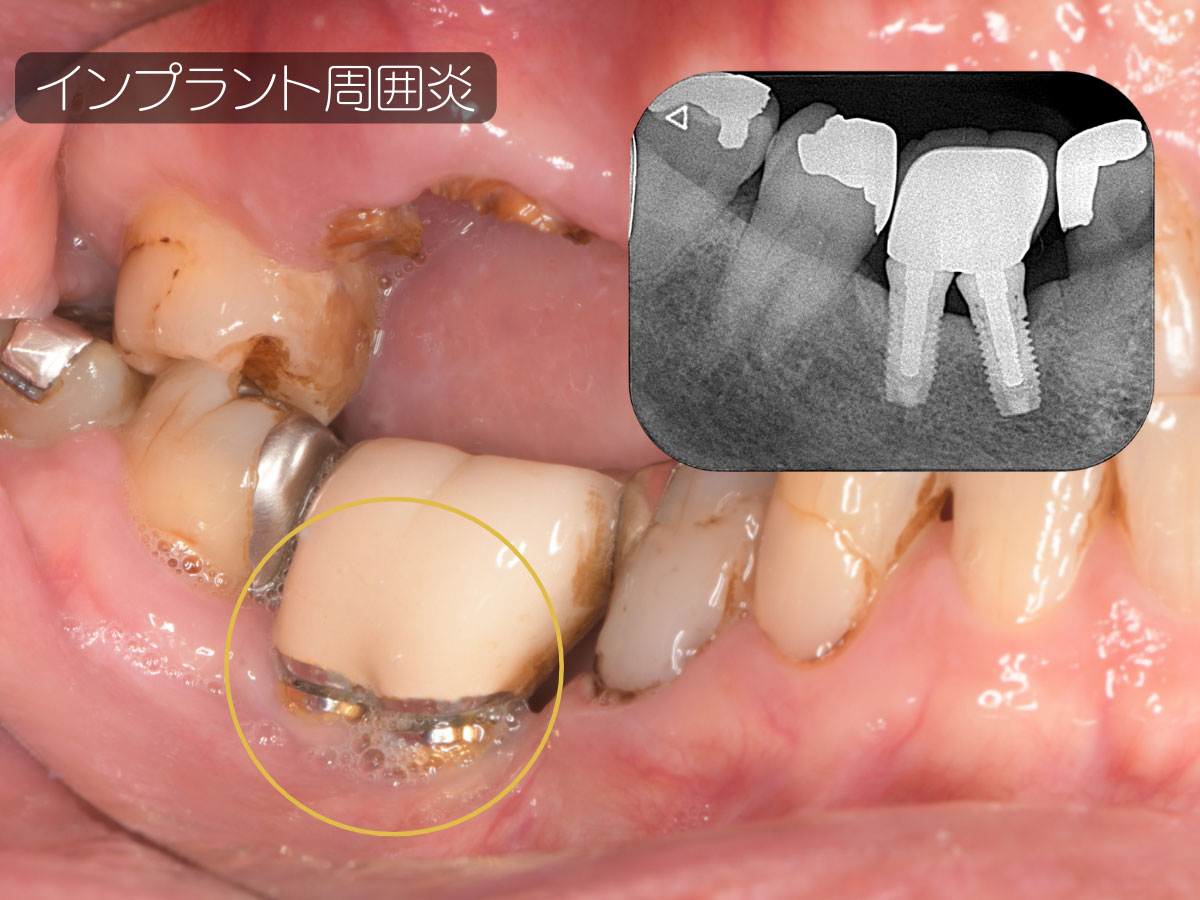 インプラント—品川で歯周病・インプラント治療を行う歯医者｜かなもり